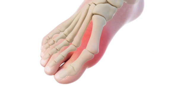 Hallux valgus