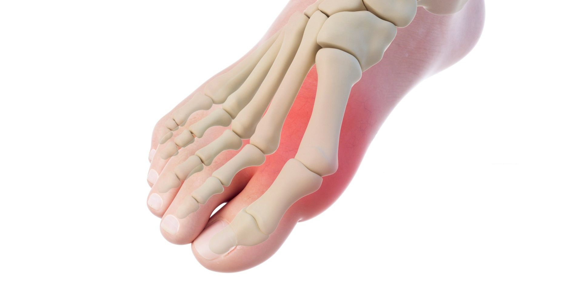 Hallux valgus